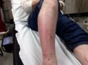 cellulitis-02.jpg